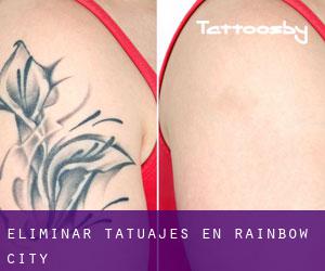 Eliminar tatuajes en Rainbow City