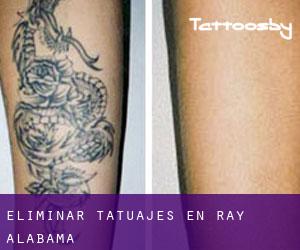 Eliminar tatuajes en Ray (Alabama)