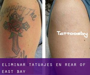 Eliminar tatuajes en Rear of East Bay