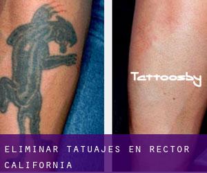 Eliminar tatuajes en Rector (California)