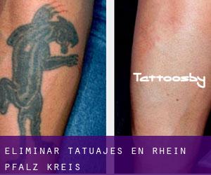 Eliminar tatuajes en Rhein-Pfalz-Kreis