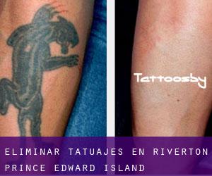 Eliminar tatuajes en Riverton (Prince Edward Island)