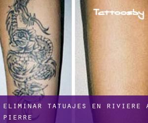 Eliminar tatuajes en Rivière-à-Pierre