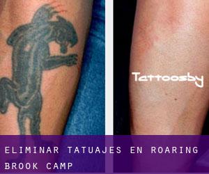 Eliminar tatuajes en Roaring Brook Camp