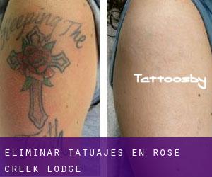 Eliminar tatuajes en Rose Creek Lodge