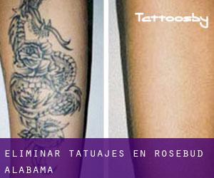Eliminar tatuajes en Rosebud (Alabama)