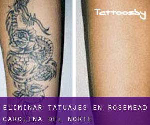 Eliminar tatuajes en Rosemead (Carolina del Norte)