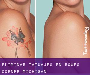 Eliminar tatuajes en Rowes Corner (Michigan)