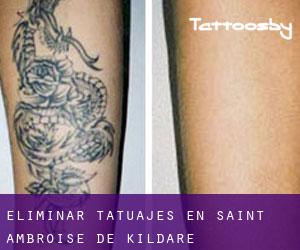 Eliminar tatuajes en Saint-Ambroise-de-Kildare