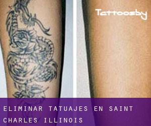Eliminar tatuajes en Saint Charles (Illinois)