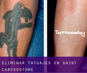 Eliminar tatuajes en Saint-Chrysostome