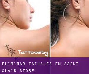 Eliminar tatuajes en Saint Clair Store