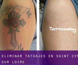 Eliminar tatuajes en Saint-Cyr-sur-Loire