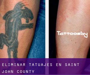 Eliminar tatuajes en Saint John County