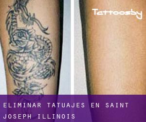 Eliminar tatuajes en Saint Joseph (Illinois)