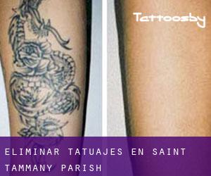 Eliminar tatuajes en Saint Tammany Parish