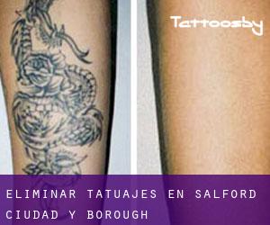 Eliminar tatuajes en Salford (Ciudad y Borough)