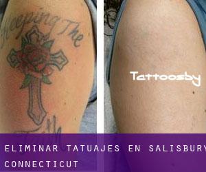 Eliminar tatuajes en Salisbury (Connecticut)