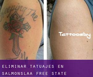 Eliminar tatuajes en Salmonslaa (Free State)