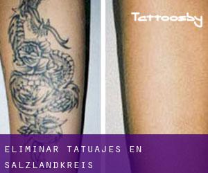 Eliminar tatuajes en Salzlandkreis