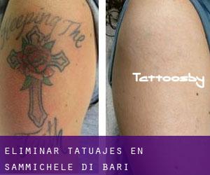 Eliminar tatuajes en Sammichele di Bari