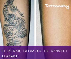 Eliminar tatuajes en Samoset (Alabama)