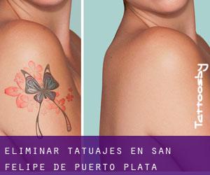 Eliminar tatuajes en San Felipe de Puerto Plata
