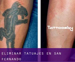 Eliminar tatuajes en San Fernando