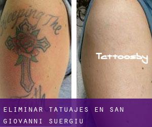 Eliminar tatuajes en San Giovanni Suergiu