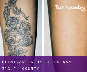 Eliminar tatuajes en San Miguel County