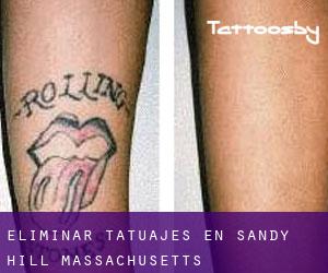 Eliminar tatuajes en Sandy Hill (Massachusetts)