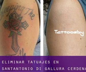 Eliminar tatuajes en Sant'Antonio di Gallura (Cerdeña)