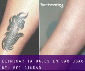 Eliminar tatuajes en São João del Rei (Ciudad)