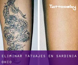 Eliminar tatuajes en Sardinia (Ohio)