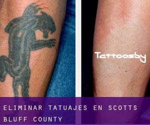 Eliminar tatuajes en Scotts Bluff County