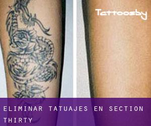 Eliminar tatuajes en Section Thirty