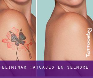 Eliminar tatuajes en Selmore