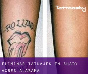 Eliminar tatuajes en Shady Acres (Alabama)