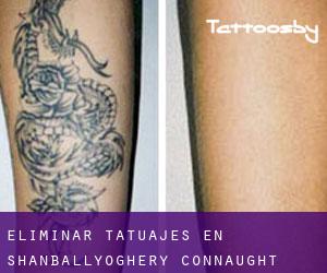 Eliminar tatuajes en Shanballyoghery (Connaught)