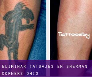 Eliminar tatuajes en Sherman Corners (Ohio)