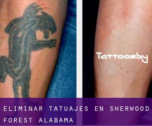 Eliminar tatuajes en Sherwood Forest (Alabama)