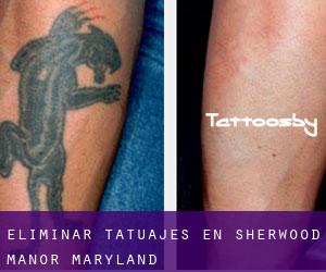 Eliminar tatuajes en Sherwood Manor (Maryland)