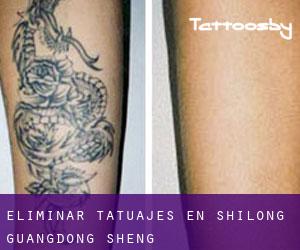 Eliminar tatuajes en Shilong (Guangdong Sheng)