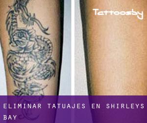 Eliminar tatuajes en Shirleys Bay