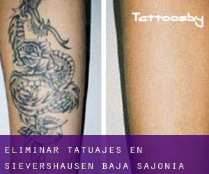 Eliminar tatuajes en Sievershausen (Baja Sajonia)