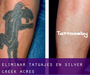 Eliminar tatuajes en Silver Creek Acres