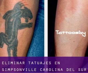 Eliminar tatuajes en Simpsonville (Carolina del Sur)