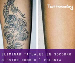 Eliminar tatuajes en Socorro Mission Number 1 Colonia