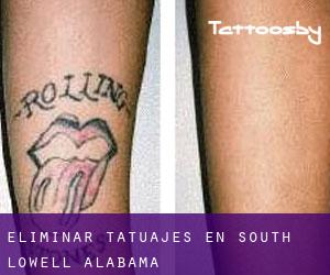 Eliminar tatuajes en South Lowell (Alabama)