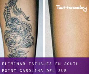 Eliminar tatuajes en South Point (Carolina del Sur)